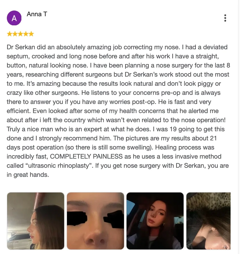 Anna T — rhinoplasty result