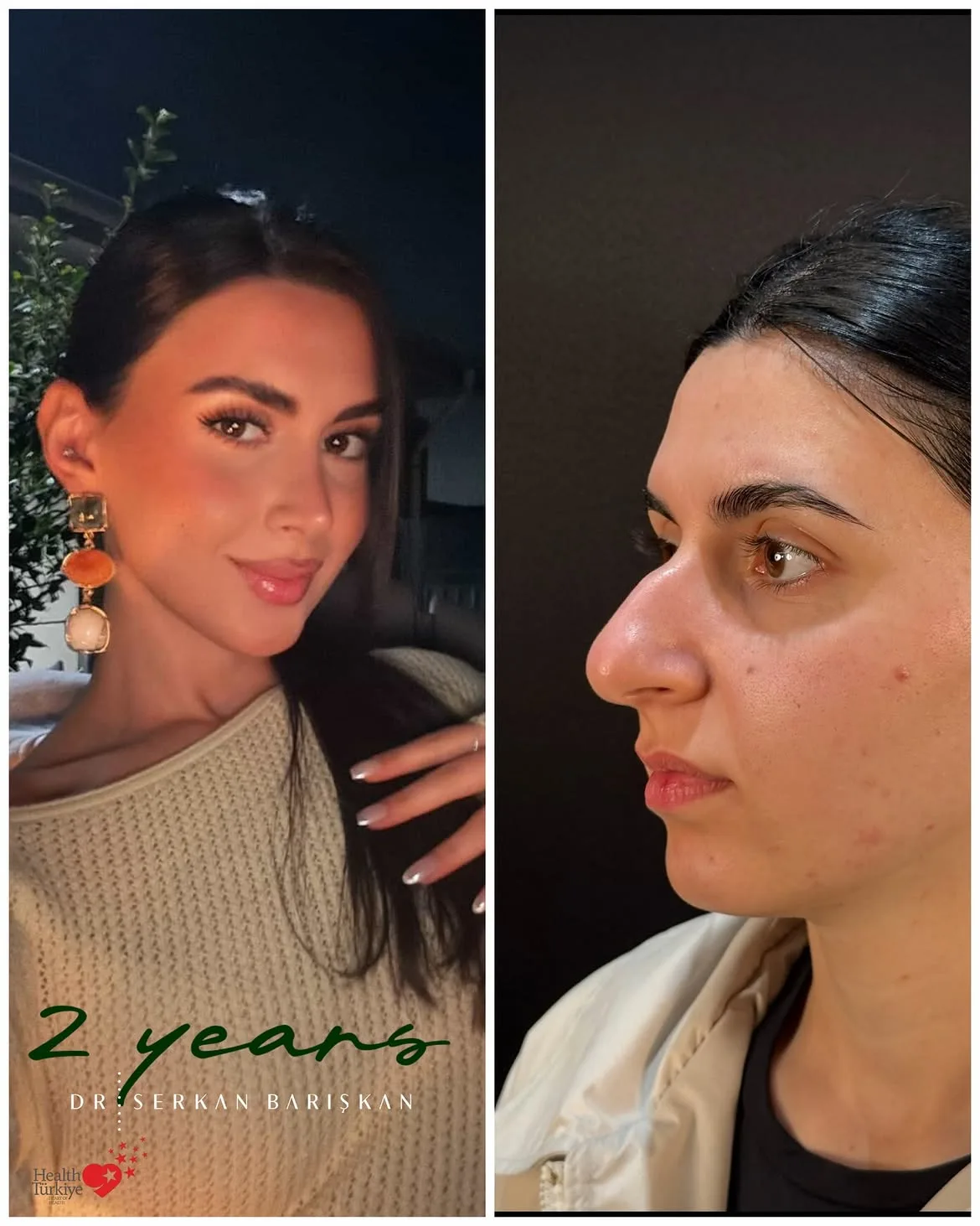 Rhinoplasty patient two years after surgery beside the pre-operative profile.