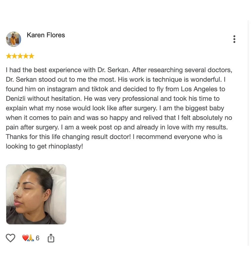 Karen Flores — rhinoplasty result