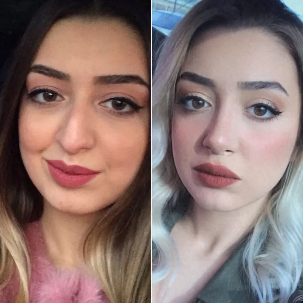 Before and after — case 10