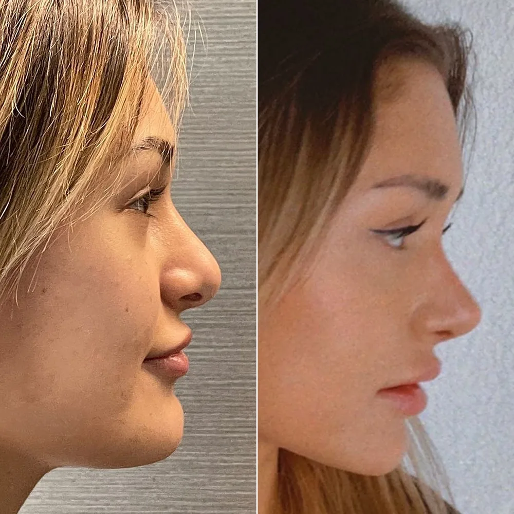 Before and after — case 04