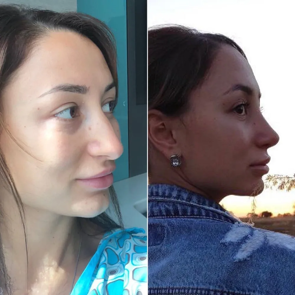 Before and after — case 14