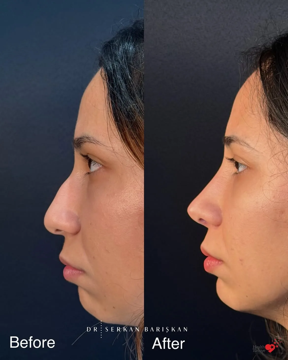 Rhinoplasty patient's pre-operative profile beside the result four years after surgery.