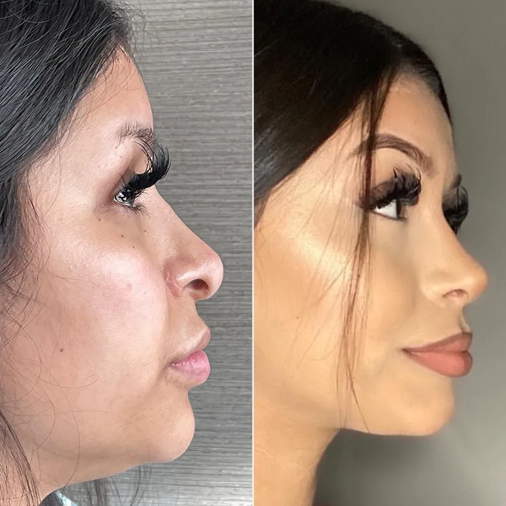 Before and after — case 11