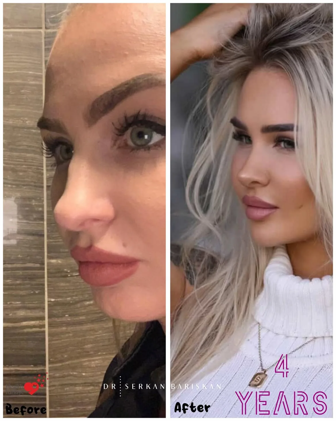 Clinical profile photographs of a rhinoplasty patient before and after surgery.