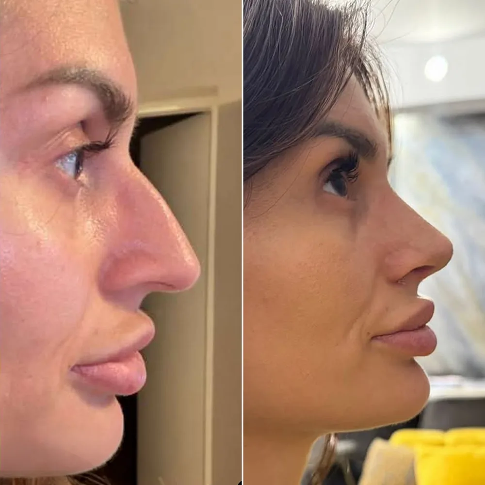 Before and after — case 13